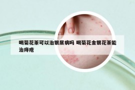 喝菊花茶可以治銀屑病嗎 喝菊花金銀花茶能治痔瘡
