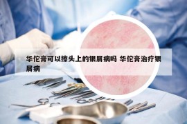 華佗膏可以擦頭上的銀屑病嗎 華佗膏治療銀屑病