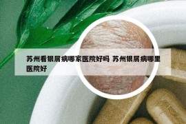 蘇州看銀屑病哪家醫(yī)院好嗎 蘇州銀屑病哪里醫(yī)院好