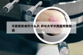 華西銀屑病開(kāi)什么藥 四川大學(xué)華西醫(yī)院銀屑病