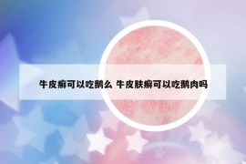 牛皮癬可以吃鵝么 牛皮膚癬可以吃鵝肉嗎