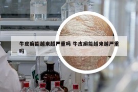 牛皮癬能越來越嚴重嗎 牛皮癬能越來越嚴重嗎
