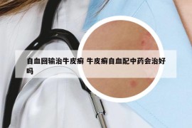 自血回輸治牛皮癬 牛皮癬自血配中藥會治好嗎