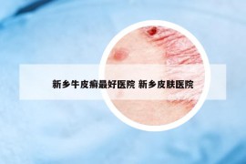新鄉(xiāng)牛皮癬最好醫(yī)院 新鄉(xiāng)皮膚醫(yī)院