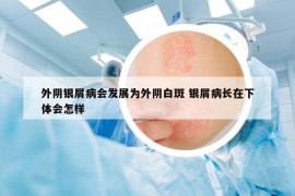 外陰銀屑病會發(fā)展為外陰白斑 銀屑病長在下體會怎樣