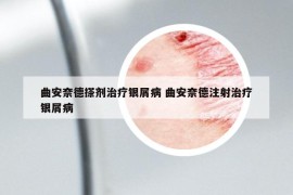 曲安奈德搽劑治療銀屑病 曲安奈德注射治療銀屑病