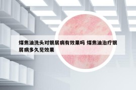 煤焦油洗頭對銀屑病有效果嗎 煤焦油治療銀屑病多久見效果