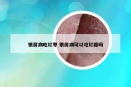 銀屑病吃紅棗 銀屑病可以吃紅糖嗎