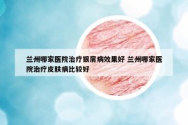 蘭州哪家醫(yī)院治療銀屑病效果好 蘭州哪家醫(yī)院治療皮膚病比較好
