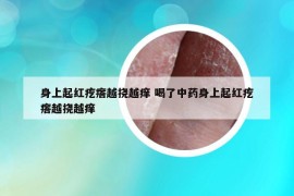 身上起紅疙瘩越撓越癢 喝了中藥身上起紅疙瘩越撓越癢