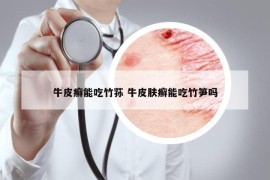 牛皮癬能吃竹蓀 牛皮膚癬能吃竹筍嗎