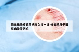修美樂治療銀屑病多久打一針 修美樂用于銀屑病能停藥嗎