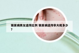 銀屑病男女遺傳比例 銀屑病遺傳率大概多少?