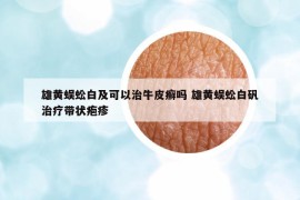 雄黃蜈蚣白及可以治牛皮癬嗎 雄黃蜈蚣白礬治療帶狀皰疹
