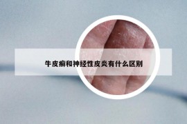 牛皮癬和神經(jīng)性皮炎有什么區(qū)別