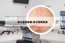 孩子患銀屑病 孩子得銀屑病