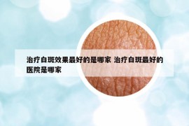 治療白斑效果最好的是哪家 治療白斑最好的醫(yī)院是哪家