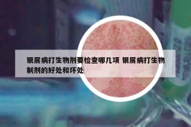 銀屑病打生物劑要檢查哪幾項 銀屑病打生物制劑的好處和壞處
