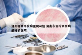 濟(jì)南哪家牛皮癬醫(yī)院可信 濟(jì)南市治療銀屑病最好的醫(yī)院