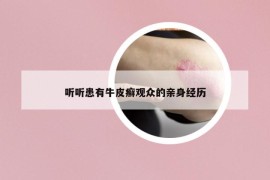 聽(tīng)聽(tīng)患有牛皮癬觀(guān)眾的親身經(jīng)歷