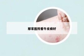 那家醫(yī)院看牛皮癬好