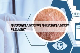 牛皮皮癬的人會(huì)發(fā)冷嗎 牛皮皮癬的人會(huì)發(fā)冷嗎怎么治療