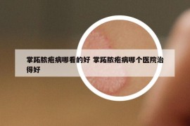 掌跖膿皰病哪看的好 掌跖膿皰病哪個(gè)醫(yī)院治得好