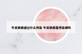 牛皮膚癬通過什么傳染 牛皮膚癬是傳染病嗎