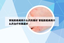 掌跖膿皰病用什么藥效果好 掌跖膿皰病用什么藥治療效果最好
