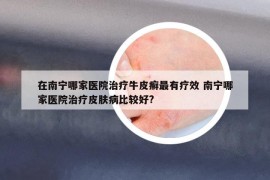 在南寧哪家醫(yī)院治療牛皮癬最有療效 南寧哪家醫(yī)院治療皮膚病比較好?