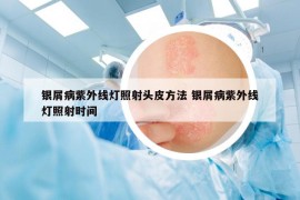 銀屑病紫外線燈照射頭皮方法 銀屑病紫外線燈照射時間