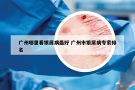 廣州哪里看銀屑病最好 廣州市銀屑病專家排名