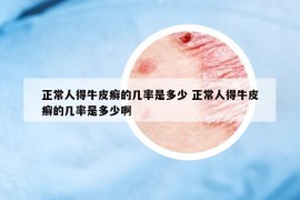 正常人得牛皮癬的幾率是多少 正常人得牛皮癬的幾率是多少啊