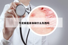 牛皮癬是身體缺什么東西嗎