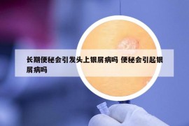 長期便秘會引發(fā)頭上銀屑病嗎 便秘會引起銀屑病嗎
