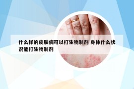 什么樣的皮膚病可以打生物制劑 身體什么狀況能打生物制劑