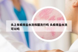 頭上有癬用鹽水洗和醋洗行嗎 頭癬用鹽水洗可以嗎