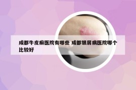 成都牛皮癬醫(yī)院有哪些 成都銀屑病醫(yī)院哪個(gè)比較好