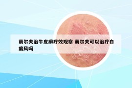 萌爾夫治牛皮癬療效觀察 萌爾夫可以治療白癜風(fēng)嗎