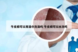 牛皮癬可以用澡巾洗澡嗎 牛皮癬可以水洗嗎