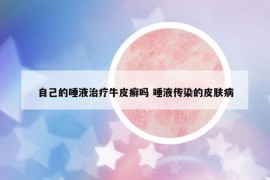 自己的唾液治療牛皮癬嗎 唾液傳染的皮膚病
