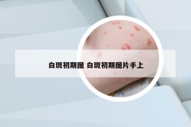 白斑初期圖 白斑初期圖片手上