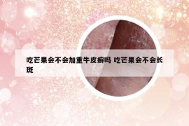 吃芒果會不會加重牛皮癬嗎 吃芒果會不會長斑