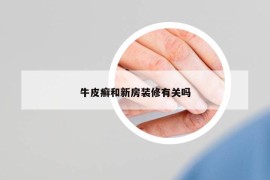 牛皮癬和新房裝修有關(guān)嗎