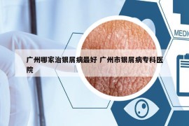 廣州哪家治銀屑病最好 廣州市銀屑病專科醫(yī)院