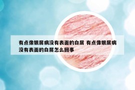 有點像銀屑病沒有表面的白屑 有點像銀屑病沒有表面的白屑怎么回事