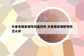 長春有銀屑病?？漆t(yī)院嗎 長春銀屑病研究所怎么樣
