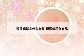 銀屑病禁食什么食物 銀屑病忌食食品