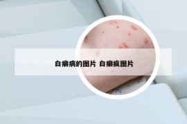 白癩病的圖片 白癩瘋圖片