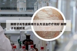 腳脖子長牛皮癬用什么方法治療療效好 腳脖子長癬脫皮